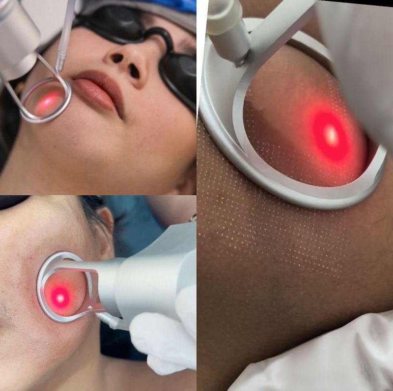 CO2 Laser Therapy CO2 Laser